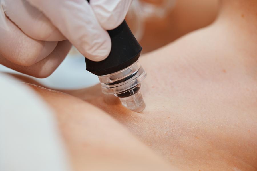 Gloved practitioner holding a microneedling handpiece with a clear tip against the upper chest of a client lying in a clinic