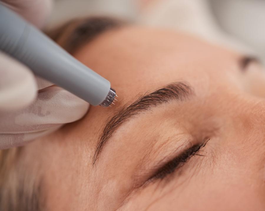 Close-up of a motorised microneedling pen tip, its fine needle array pressed to the skin above a client’s eyebrow