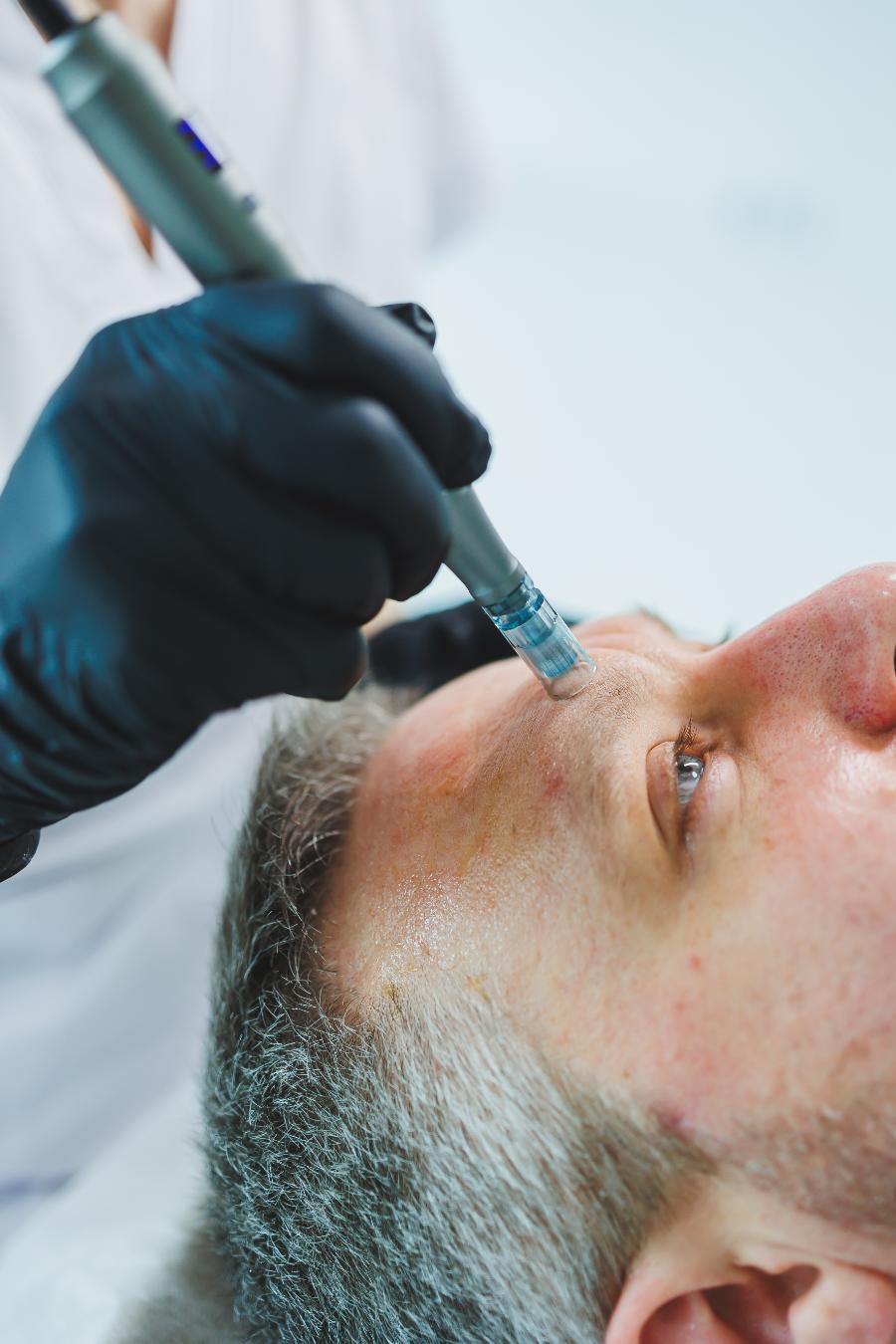 A microneedling pen being drawn across the forehead of a bearded man reclining in a treatment chair