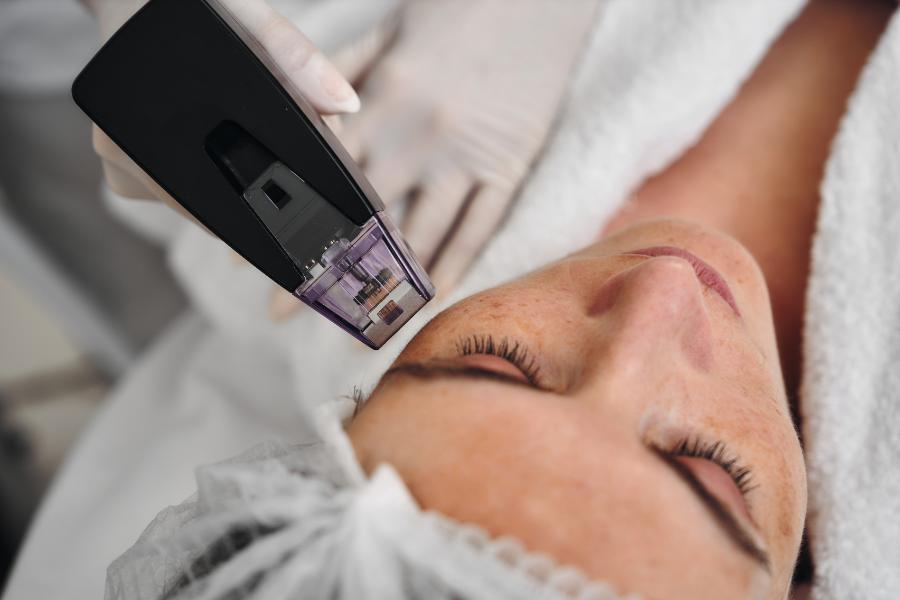 Practitioner positioning a radiofrequency microneedling handpiece and its cartridge tip over a client’s cheek